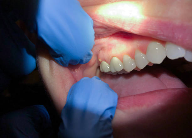 Best Emergency Wisdom Teeth Removal in Shell Ridge, CA